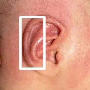 【科普】为什么新生儿耳廓畸形越早治疗越好？(图6)