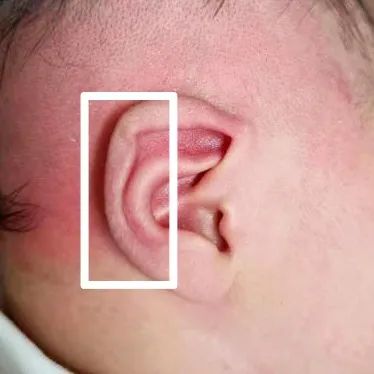 【科普】为什么新生儿耳廓畸形越早治疗越好？(图5)
