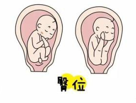 【科普】临近预产期宝宝还是臀位？臀位外倒转术助力顺产！(图6)