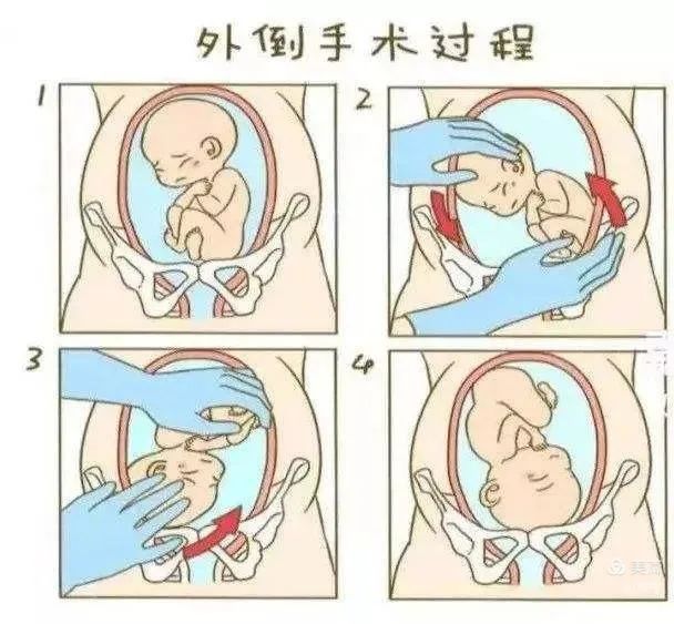 【科普】临近预产期宝宝还是臀位？臀位外倒转术助力顺产！(图5)
