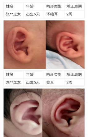 一组对比图鉴，带你直击神奇的「新生儿耳廓畸形无创矫形术」(图3)