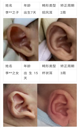 一组对比图鉴，带你直击神奇的「新生儿耳廓畸形无创矫形术」(图4)