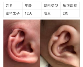 一组对比图鉴，带你直击神奇的「新生儿耳廓畸形无创矫形术」(图6)