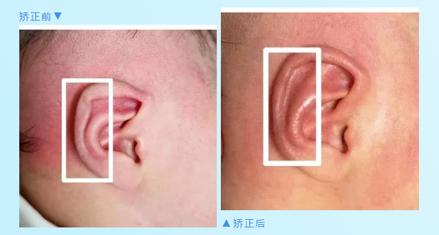 一组对比图鉴，带你直击神奇的「新生儿耳廓畸形无创矫形术」(图7)