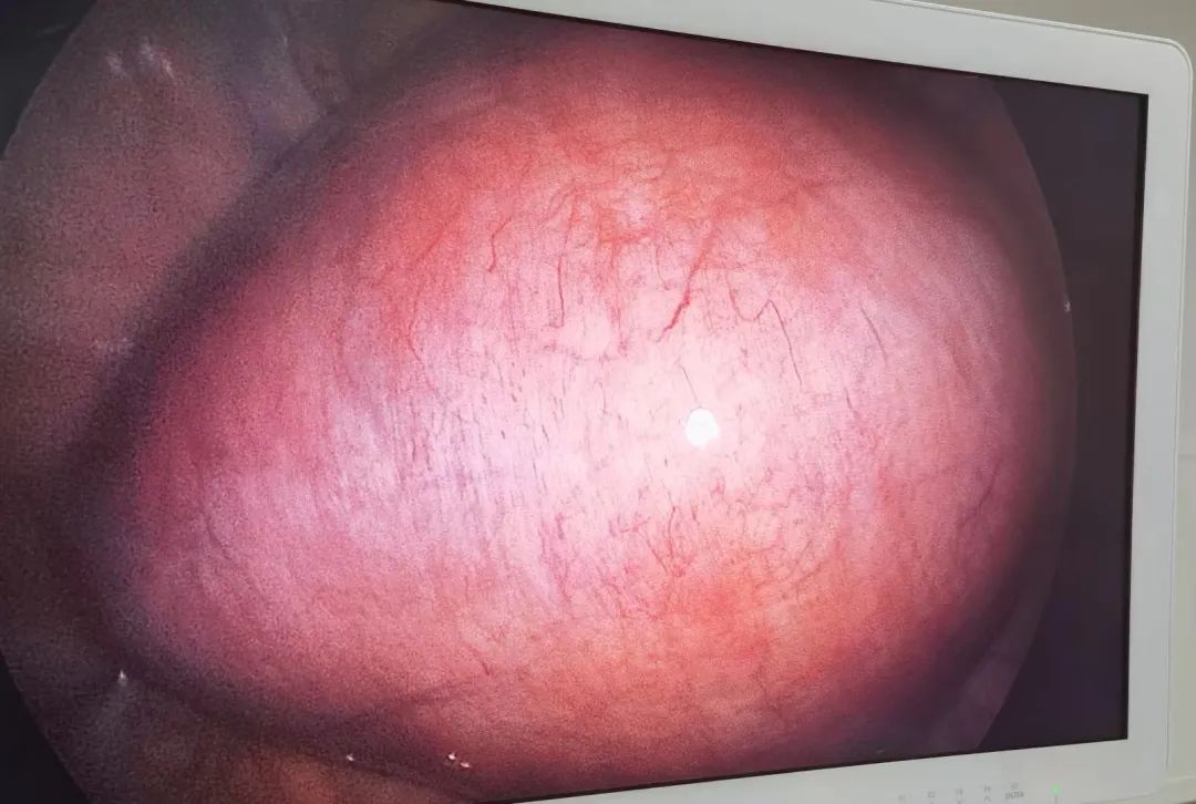 【案例分享】惊！「西瓜」大小的子宫肌瘤，取出的瘤体比人还高！(图2)