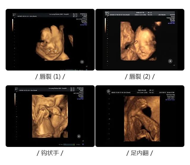 【科普】孕妈必备|关于产前大排畸要知道些什么?小锦来帮大家捋一捋!(图8) 【科普】孕妈必备|关于产前大排畸要知道些什么?小锦来帮大家捋一捋!(图8)