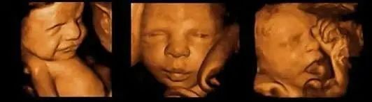 【科普】孕妈必备|关于产前大排畸要知道些什么?小锦来帮大家捋一捋!(图10) 【科普】孕妈必备|关于产前大排畸要知道些什么?小锦来帮大家捋一捋!(图10)